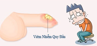 Hẹp bao quy đầu có con được không