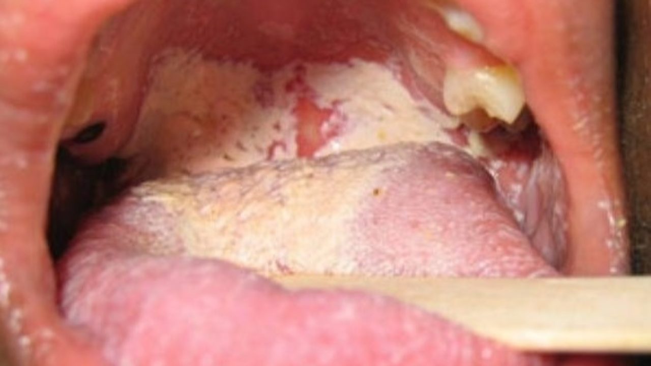 hình ảnh bệnh lậu ở nam và nữ giới