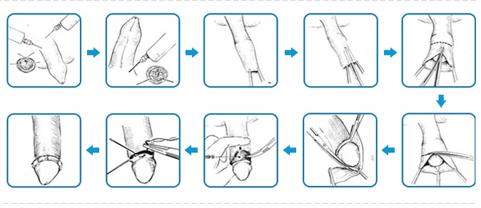 cách lột bao quy đầu tại nhà hiệu quả