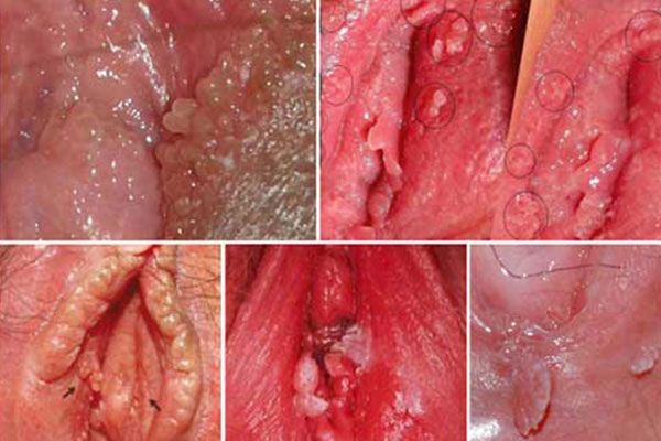 Nổi hạch ở môi lớn bệnh gì và Cách chữa trị bệnh tại nhà