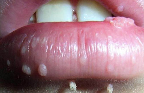 Cách chữa bệnh sùi mào gà ở lưỡi tại nhà