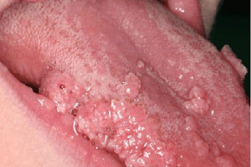 Cách trị bệnh sùi mào gà ở lưỡi tại nhà