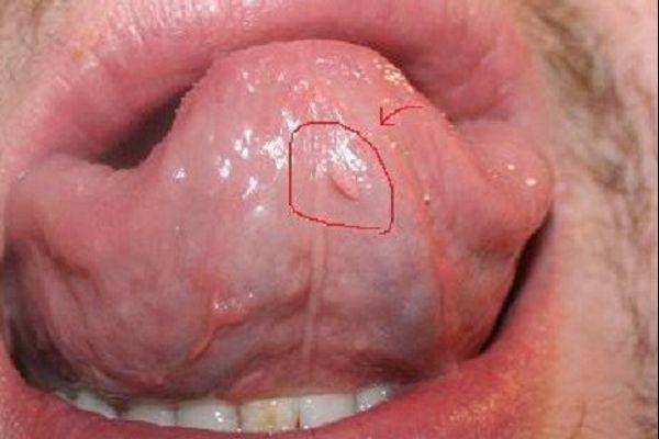 Cách trị sùi mào gà ở lưỡi tại nhà