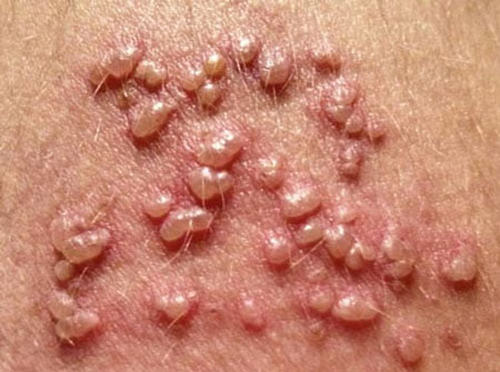 mụn sinh dục ở vùng kín nữ