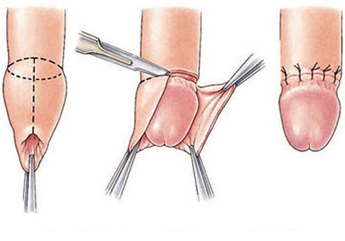 Các Phương Pháp Điều Trị Rối Loạn Cương Dương