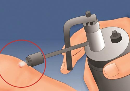 Thuốc bôi gai sinh dục an toàn và hiệu quả tại nhà
