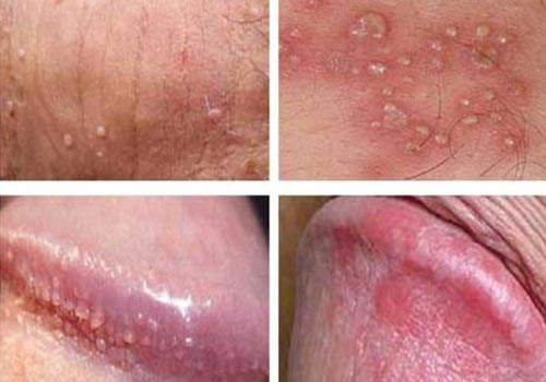 Chi phí chữa viêm bao quy đầu hết bao nhiêu tiền