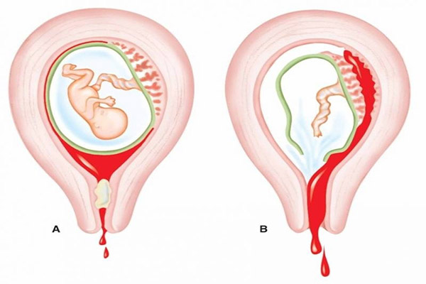 Nguyên nhân và dấu hiệu nhận biết của sót nhau thai