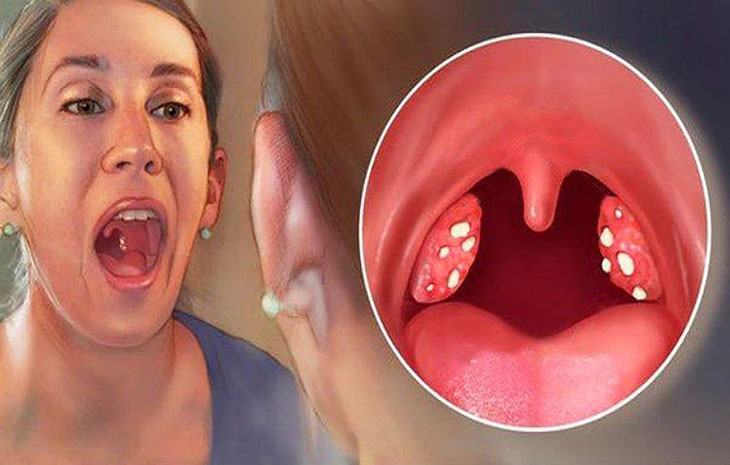 Viêm amidan hốc mủ 1 bên: Triệu chứng và Cách điều trị