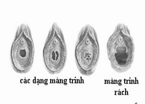 Mất trinh rồi có kinh nguyệt không