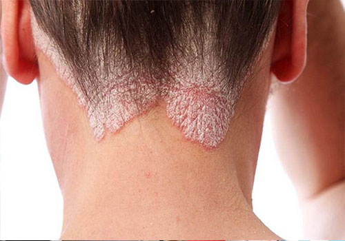 Những bệnh về da nguy hiểm cần chú ý