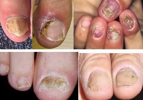 Nấm móng tay có nguy hiểm không và tự khỏi được không