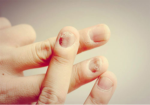 Nấm móng tay có nguy hiểm không và tự khỏi được không