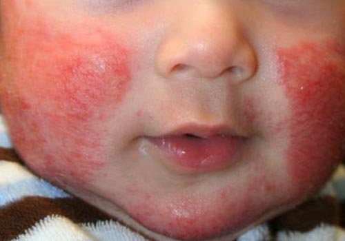 Cách trị chàm sữa theo dân gian hiệu quả nhất