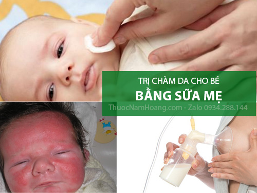 Cách trị chàm sữa bằng sữa mẹ như thế nào và hiệu quả không