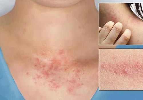 Nhiễm trùng da có mủ có nguy hiểm không và cách chữa trị