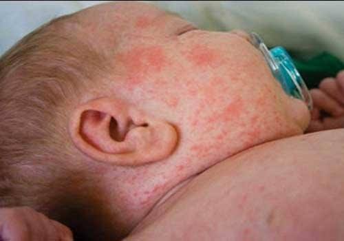 Cách điều trị viêm da mủ ở trẻ sơ sinh