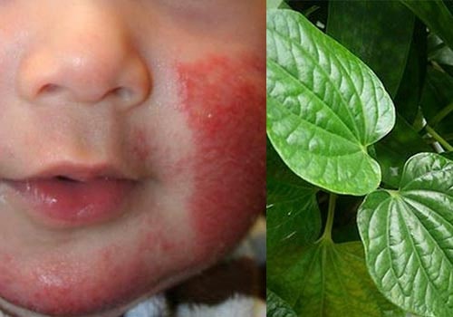 Cách điều trị viêm da mủ ở trẻ sơ sinh