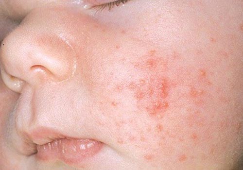 Cách điều trị viêm da mủ ở trẻ sơ sinh