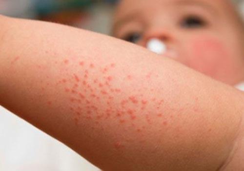 Da bé bị nổi sần như da gà là bị gì và Cách chữa trị