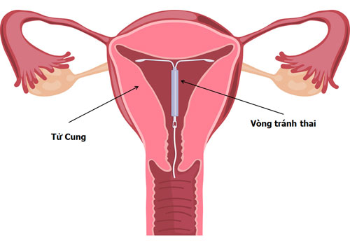 Cách đặt vòng nội tiết quy trình từng bước