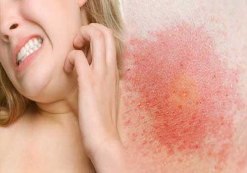Da bị nổi sần và ngứa là bị gì và cách chữa trị