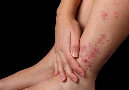Những bệnh về da nguy hiểm cần chú ý
