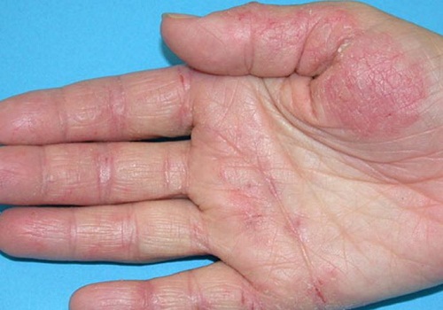 Những bệnh về da nguy hiểm cần chú ý