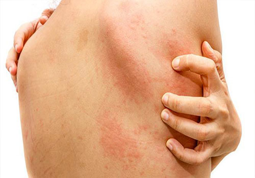 Bệnh Phong Lạnh Nổi Mề Đay Là Gì và Nguy Hiểm Không