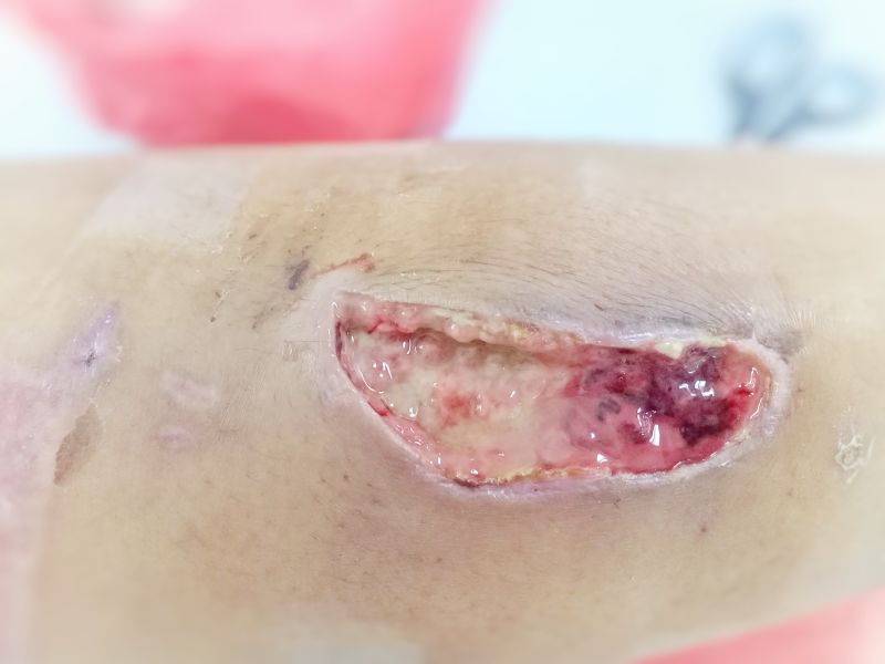 Pressure injury and ulcers: Prevention staging and treatment