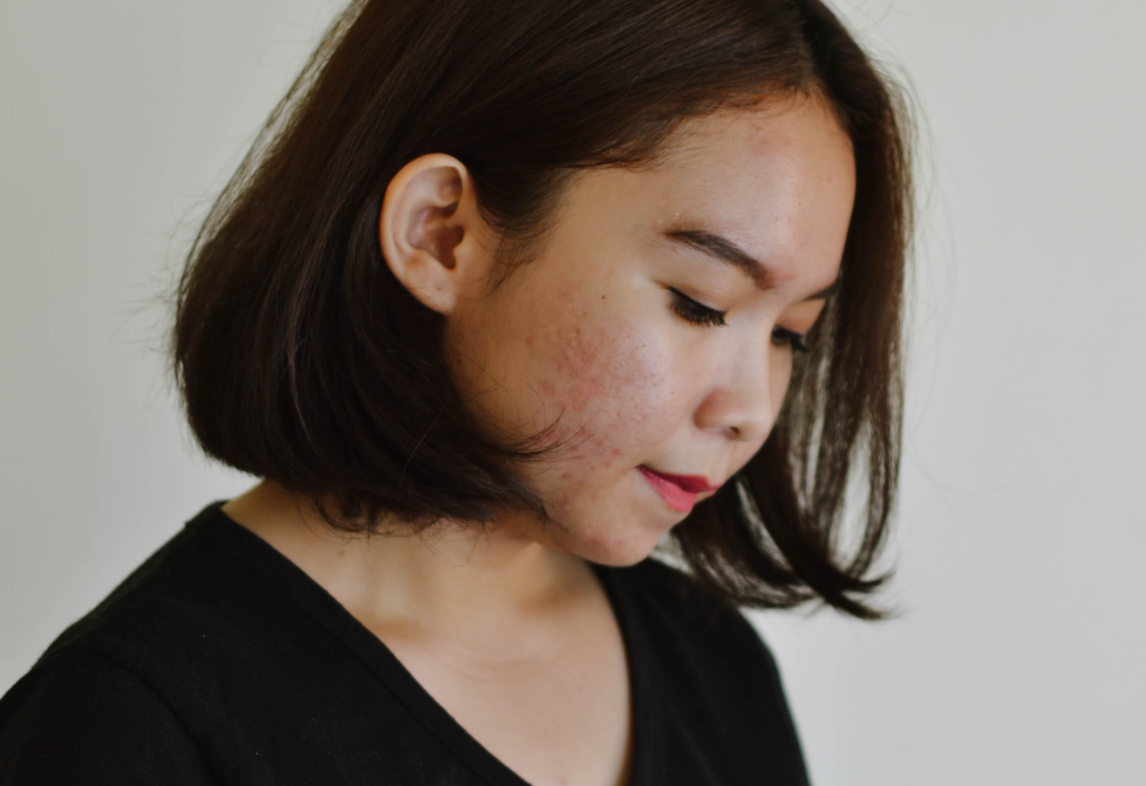 Improve Dry Irritated Skin With Hashimoto S Paloma Health