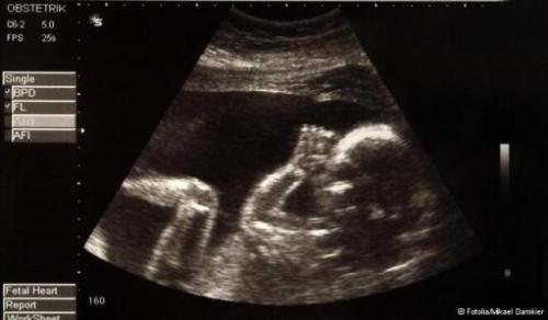 aborto selectivo en europa