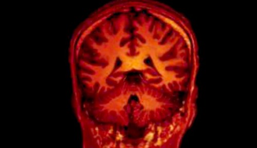 escaneo del cerebro