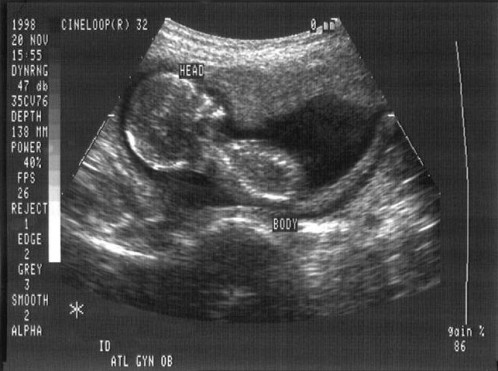 ecografia de un bebe