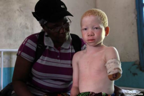 albino atacado en tanzania