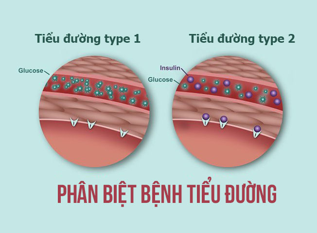 tieu duong la gi