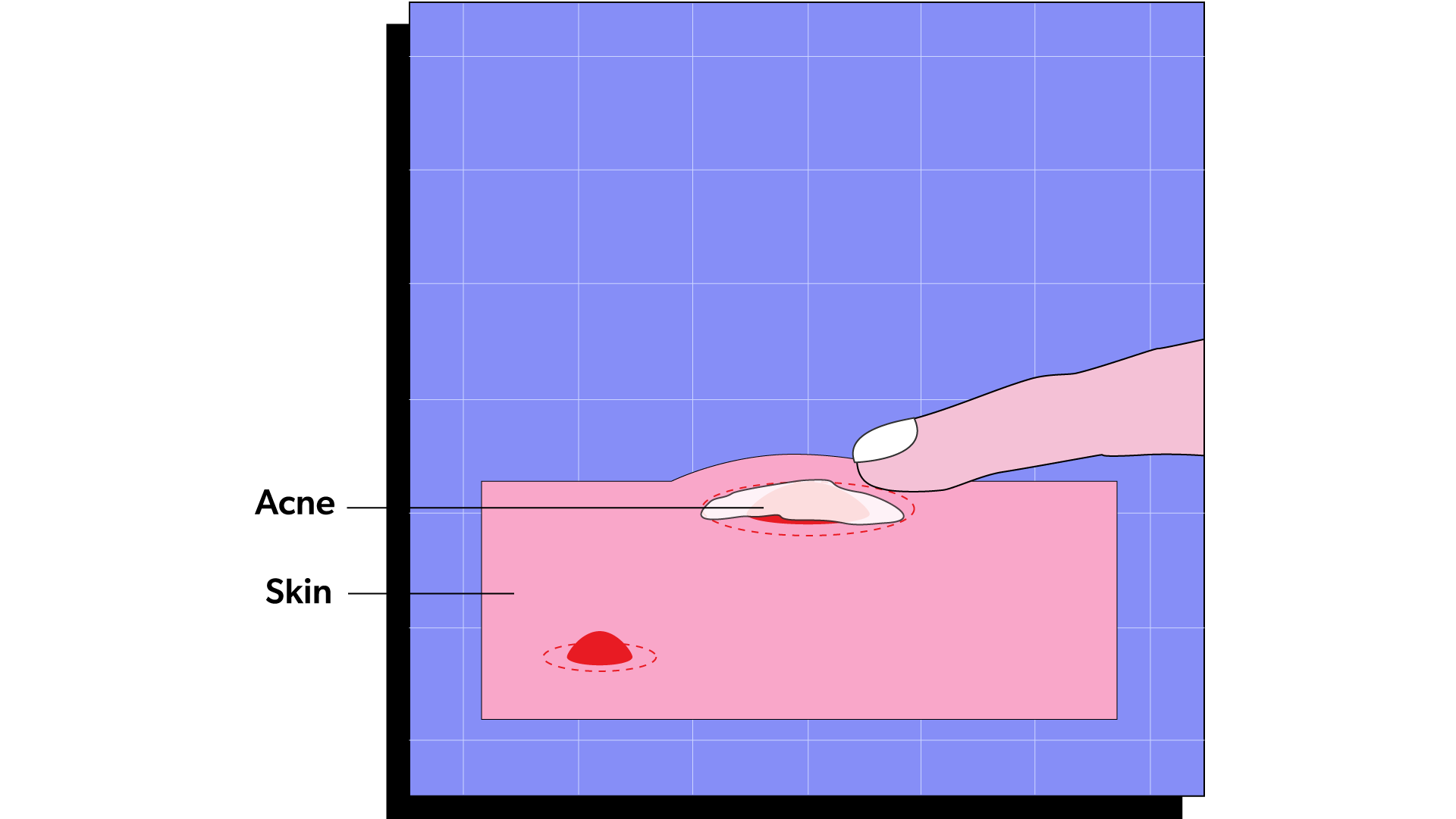 Massage the acne treatment through