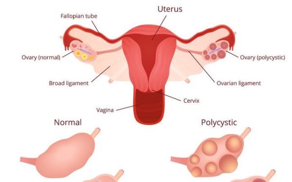 Những chị em bị buồng trứng đa nang thường có chu kỳ kinh nguyệt không đều.