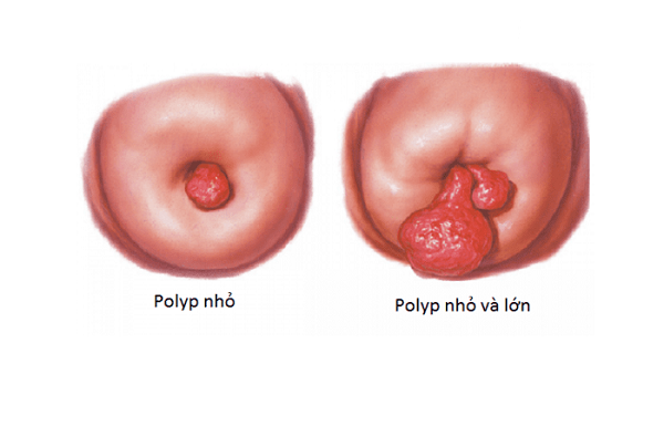 Polyp cổ tử cung là một trong những bệnh lý phụ khoa không hiếm gặp