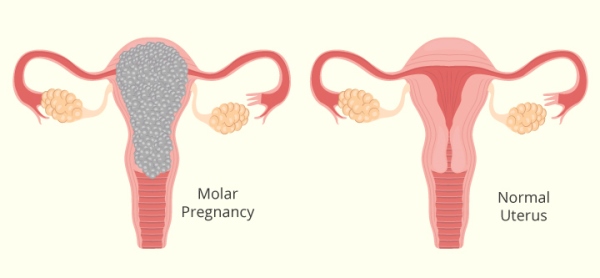 Thai trứng là tình trạng một phần hay toàn bộ bánh rau bị thoái hóa thành các túi chứa dịch to, nhỏ, dính vào nhau thành từng chùm như chùm nho.