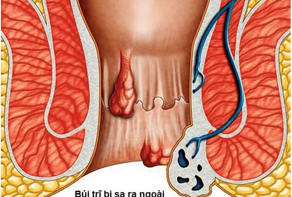 xuat-hien-sa-bui-tri
