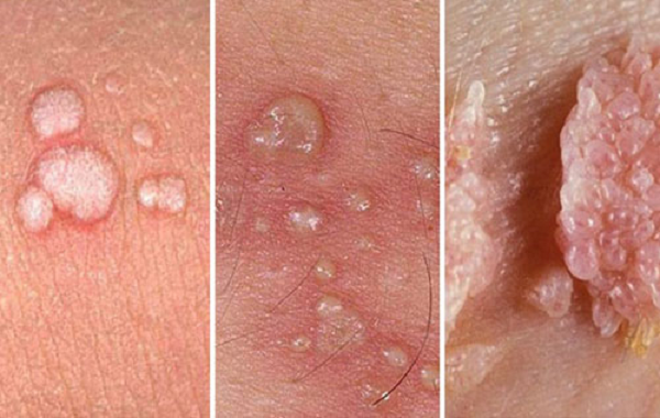 Giai đoạn phát triển của mụn cóc sinh dục