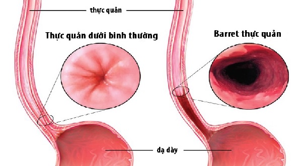 Barrett thực quản là yếu tố nguy cơ chính gây ung thư thực quản