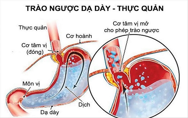 Trào ngược dạ dày có nguyên nhân từ thực quản, dạ dày hoặc các cơ quan khác trong cơ thể