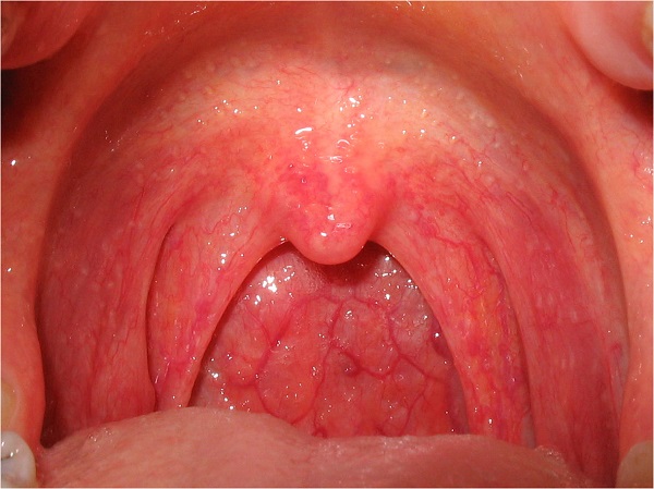 bệnh viêm họng cấp ở trẻ em nguyên nhân do virus, vi khuẩn, nấm gây ra