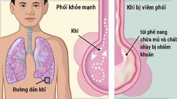 Nguyên nhân gây viêm phổi ở trẻ em