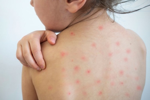 Bệnh sởi là bệnh truyền nhiễm dễ bùng phát trên diện rộng, trẻ nên được vắc xin ngừa bệnh sởi