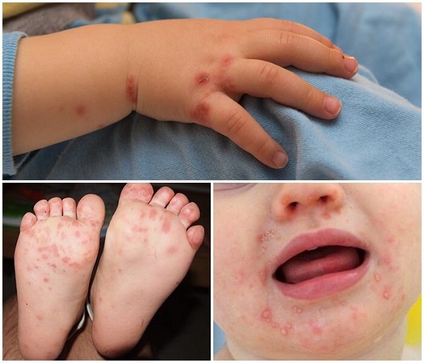 Bệnh tay chân miệng là bệnh truyền nhiễm dễ lây lan nếu nặng có thể gây di chứng thần kinh rất nguy hiểm