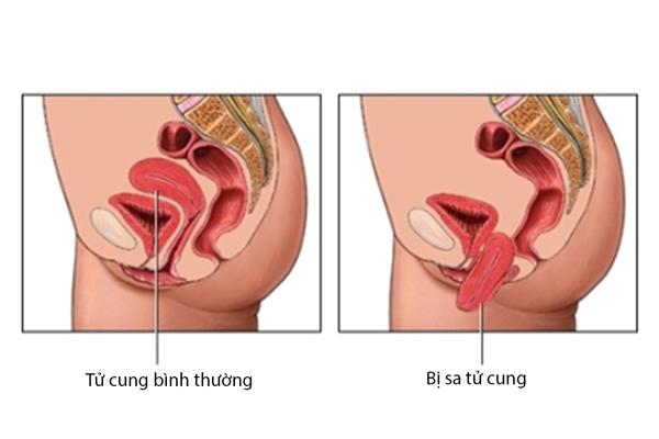 Sa tử cung gồm 5 giai đoạn khác nhau