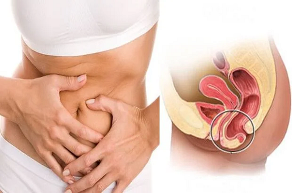 Tắc vòi trứng là nguyên nhan hàng đầu của mang thai ngoài tử cung